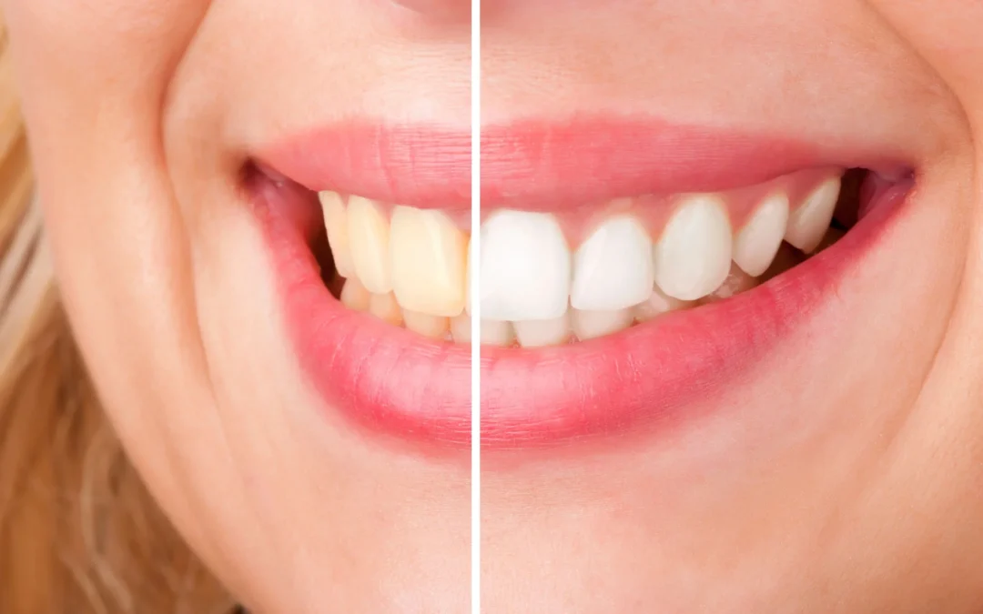 How to Know Which Cosmetic Treatment Is Right for Your Smile 