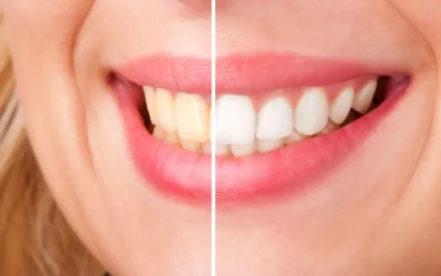 How to Know Which Cosmetic Treatment Is Right for Your Smile 
