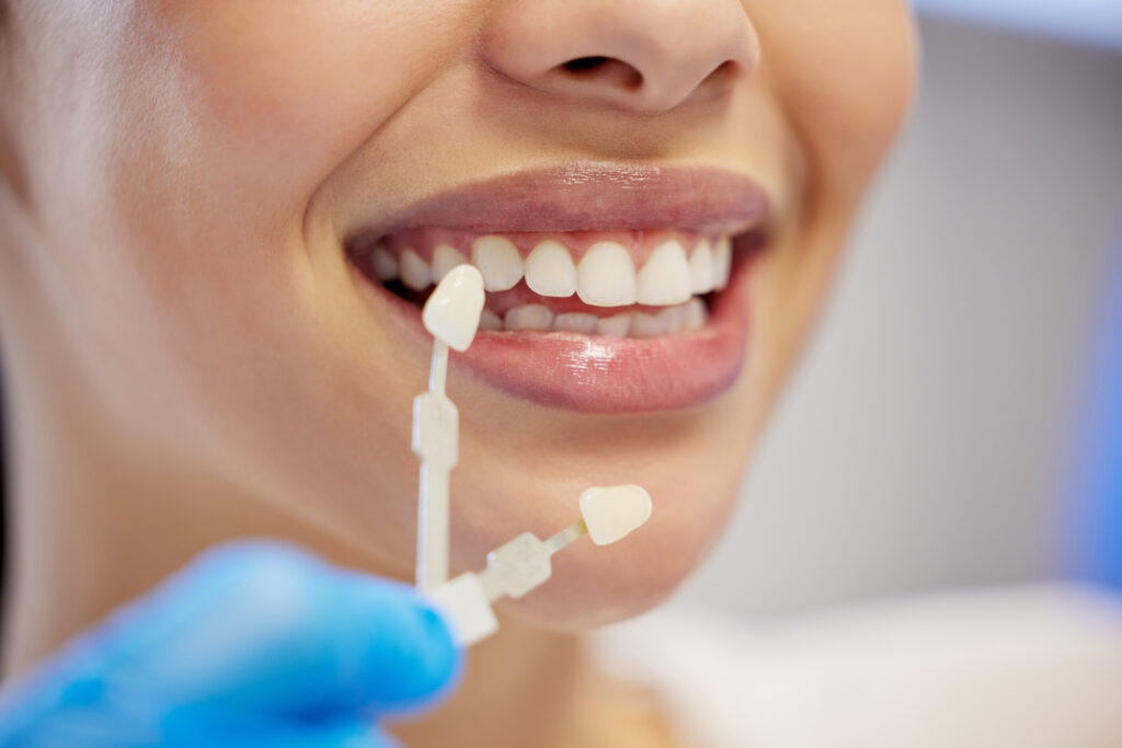 Shade-matching-for-Veneers-in-Upper-East-Side-cosmetic-treatment