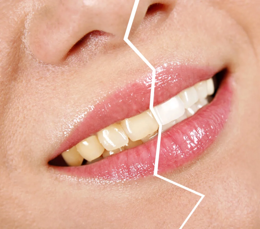 before-after-brighter-smile