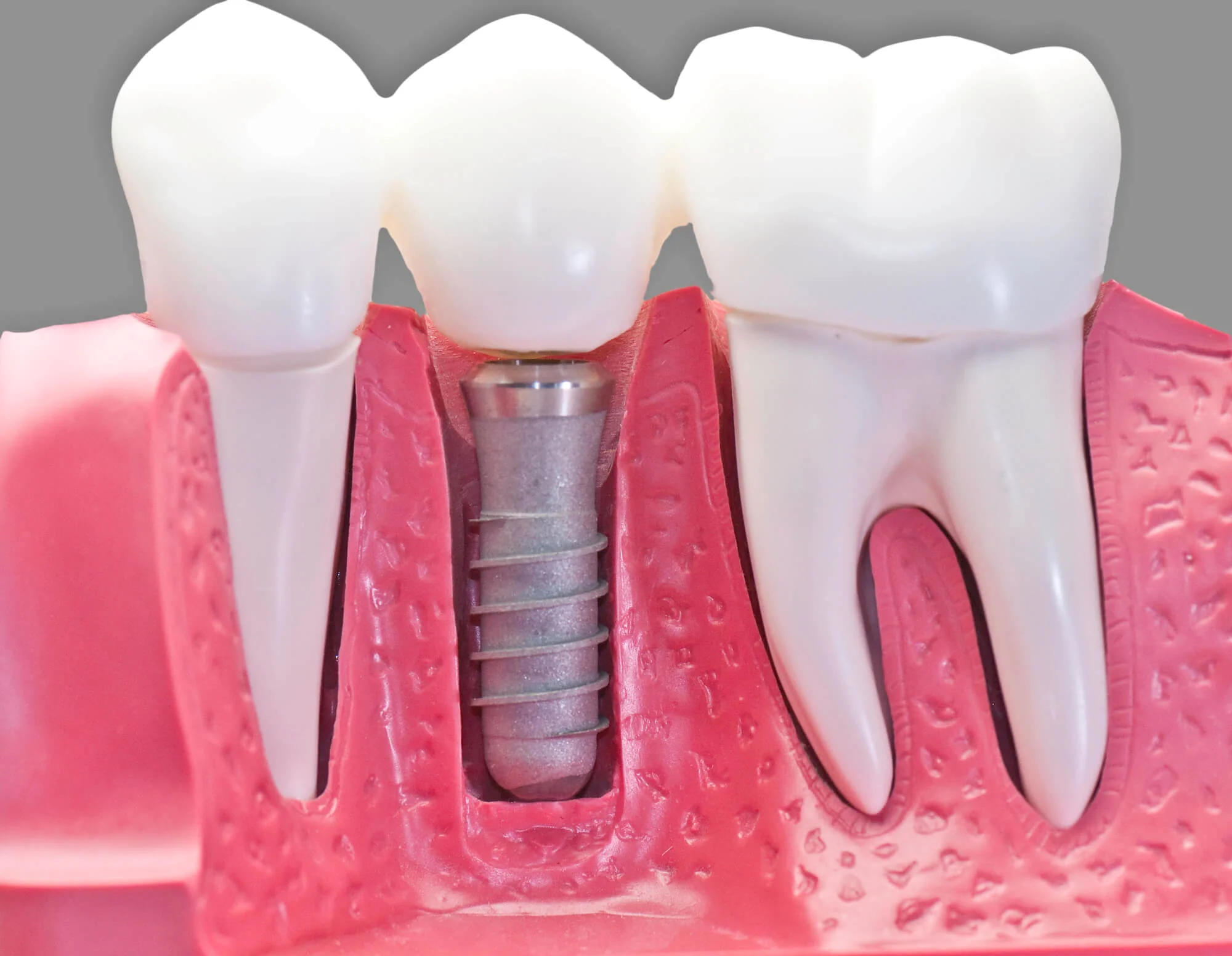 model-of-dental-implants-Upper-East-Side