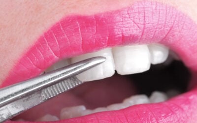 How Long Do Porcelain Veneers Last?