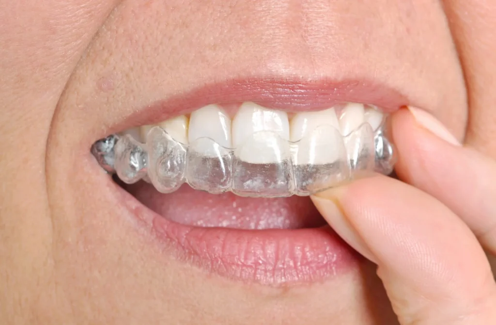 Patient wearing Invisalign in Upper East Side aligners